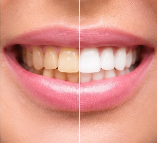 Bleaching Berlin – Philips Zoom FamDental
