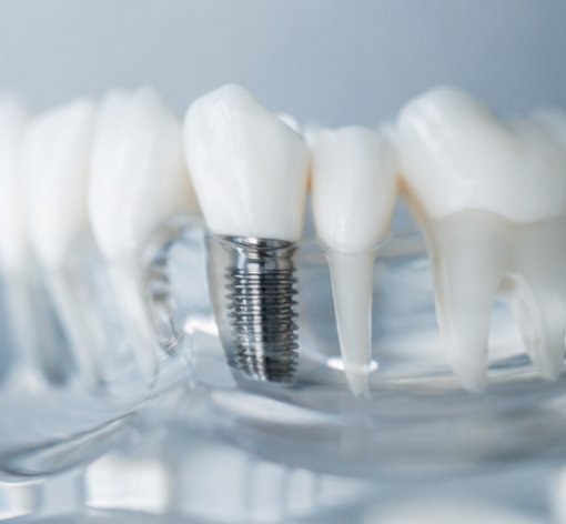 Implantology Berlin Mitte – FamDental