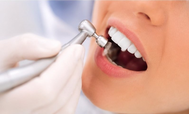 Professional teeth cleaning Berlin – FamDental